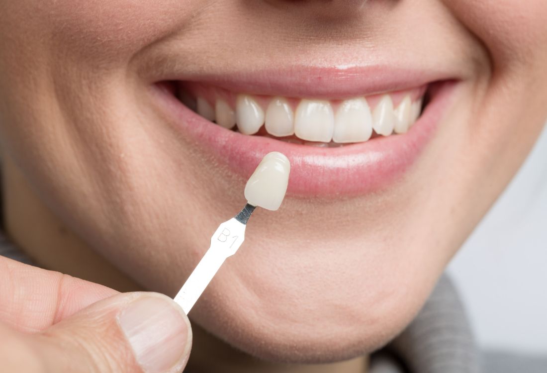 Dental Veneers: An Overview of the Procedure and Its Benefits