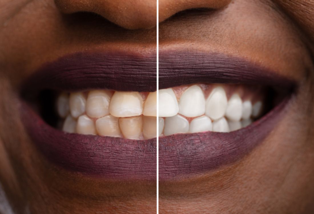 The Different Types of Teeth Whitening Treatments and Which One is Right for You